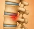 Doença Discal Degenerativa: Desgaste de Discos Intervertebrais